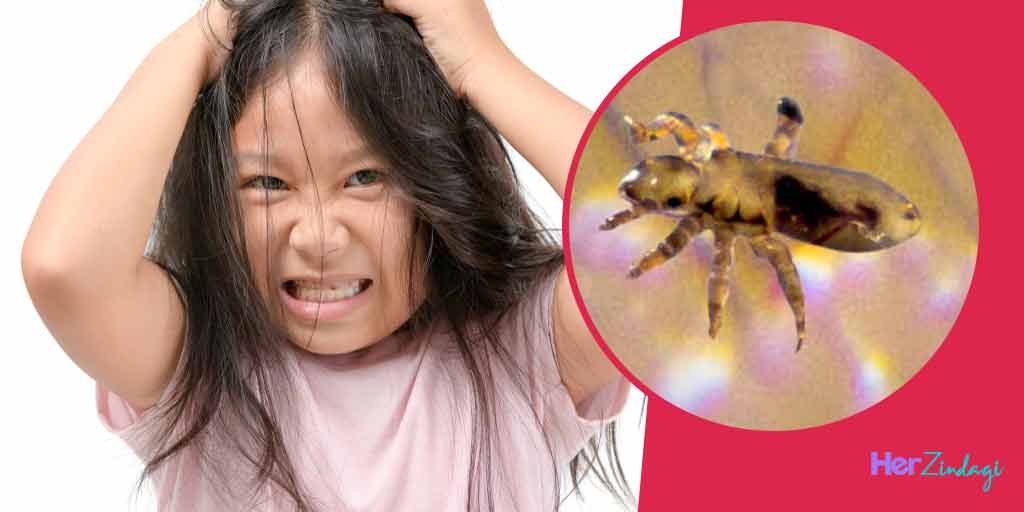 How to Get Rid of Lice Super Fastजूं से छुटकारा पाने के सुपर फास्ट