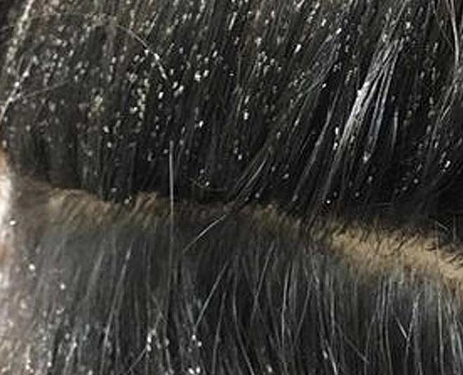 How to Get Rid of Lice Super Fast how to get rid of lice super fast