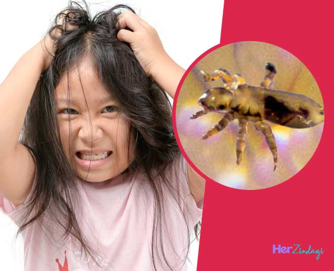 how-to-get-rid-of-lice-super-fast-how-to-get-rid-of-lice-super-fast