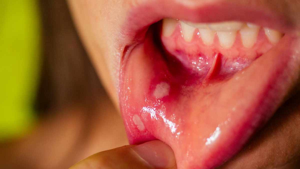 best foods for mouth ulcer