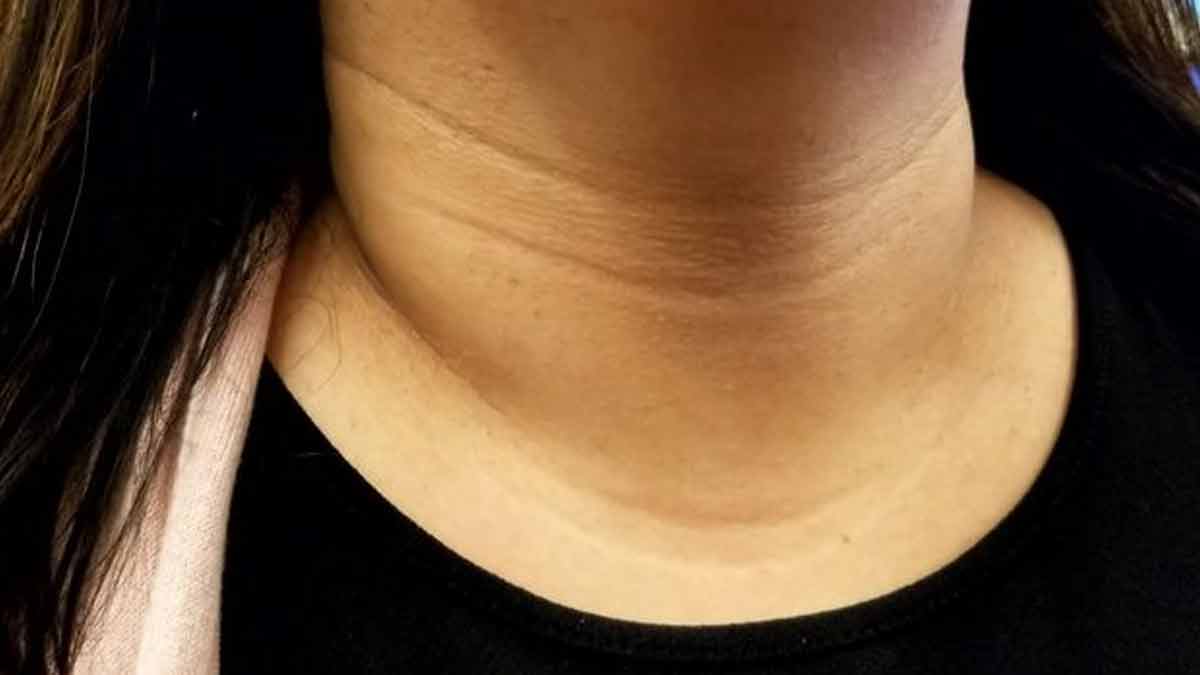 how to get rid of neck wrinkles young people
