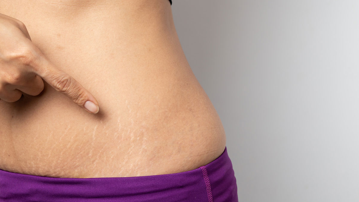 how to reduce belly stretch marks