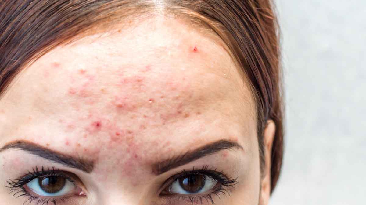 remedies for acne between eyebrows hindi