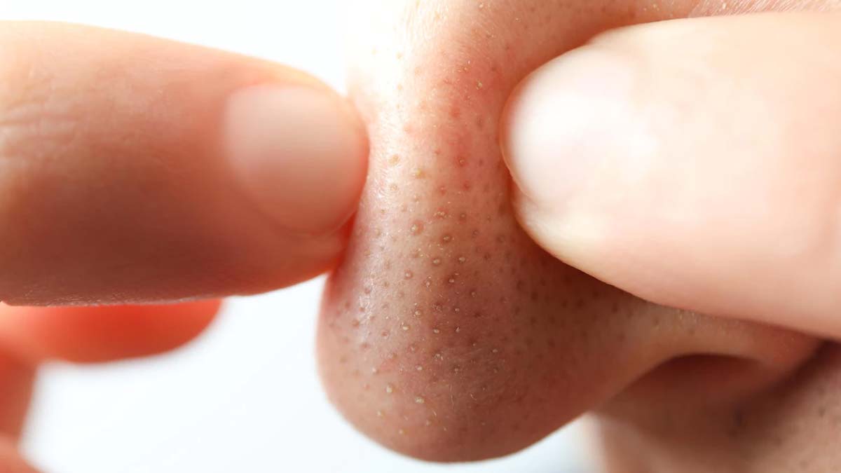 remove whiteheads with oatmeal ()