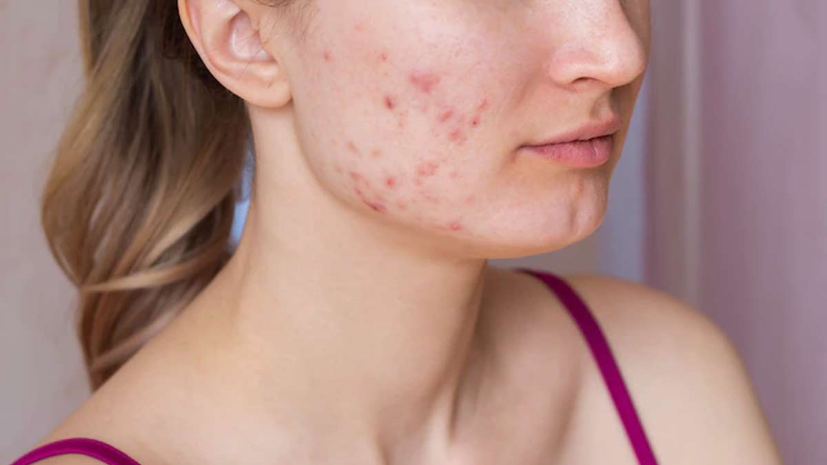 How acne can be problamatic