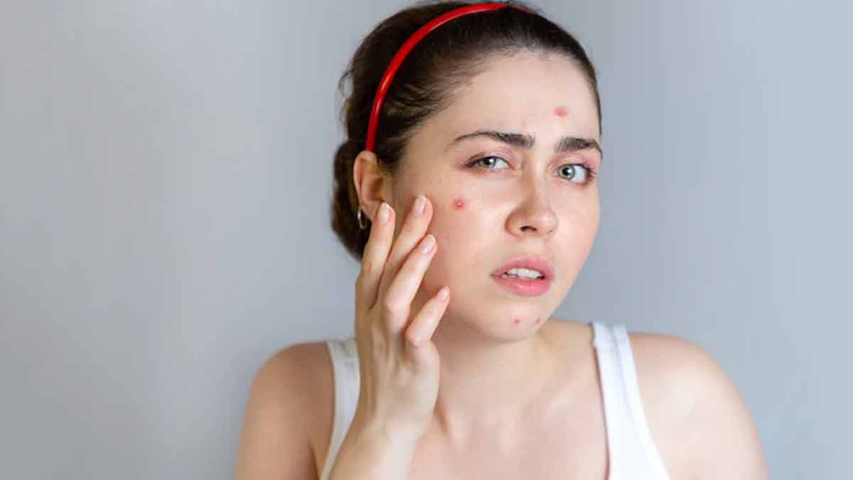 acne on skin problems