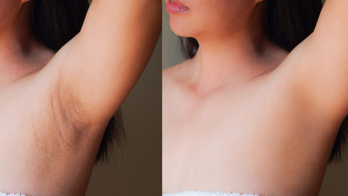 black under arms solution