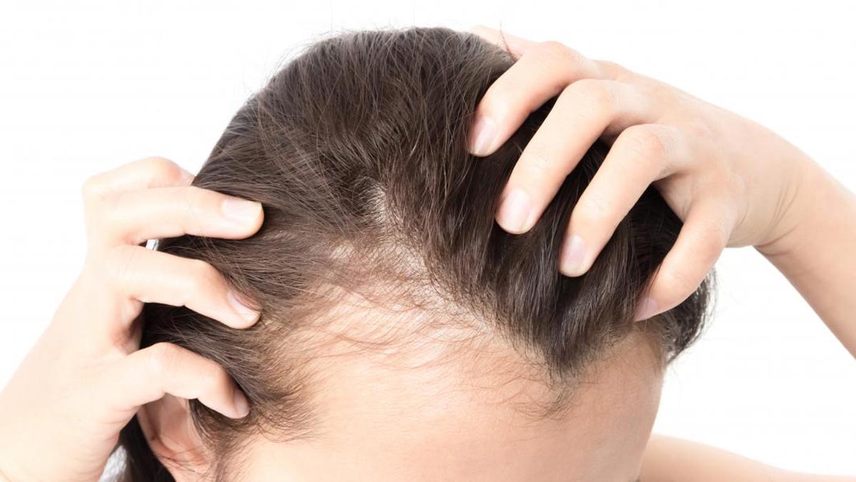 causes of hair thinning in females