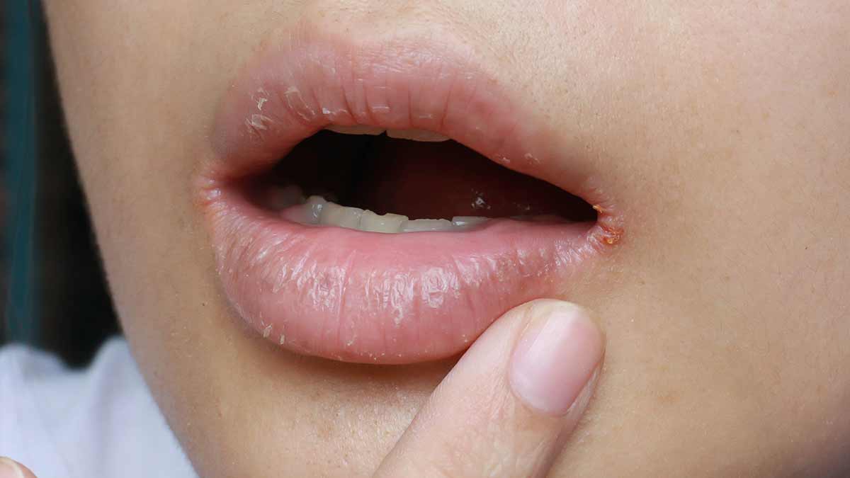 cracked lip corners reasons hindi