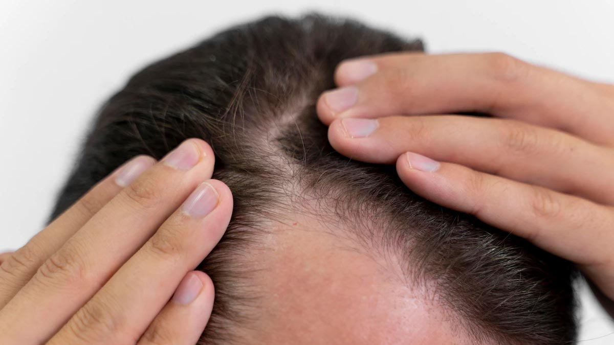 hair thinning in females and causes