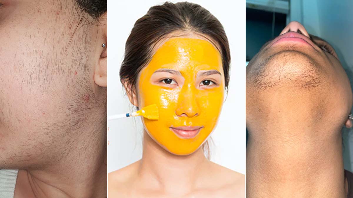 DIY Facial Hair Removal Mask  Naturally  Permanently at Home  YouTube