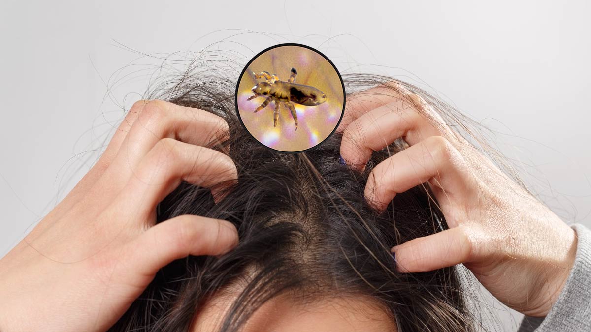 Head lice  Symptoms and causes  Mayo Clinic