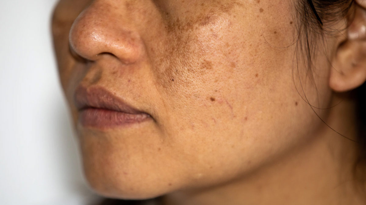 pigmentation treatment with green tea pic
