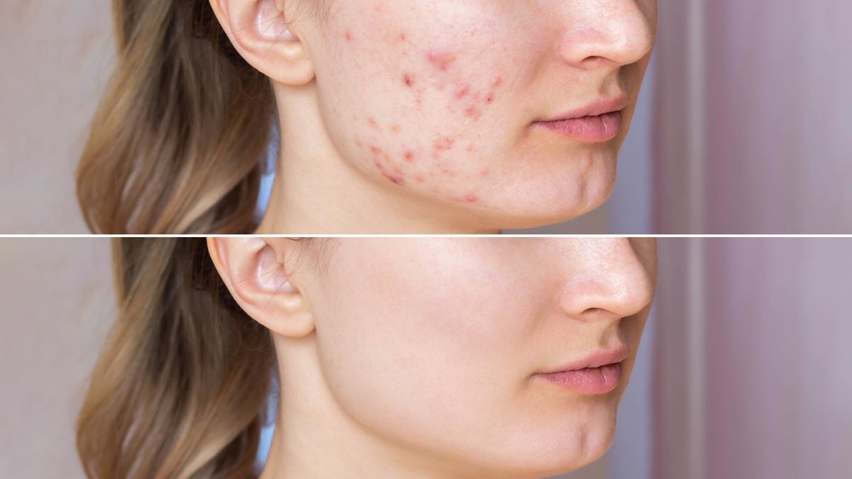 pimples dark spots remedies