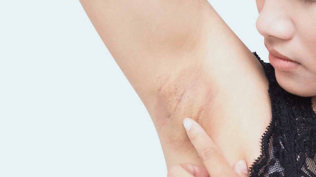 problems with underarms darkness
