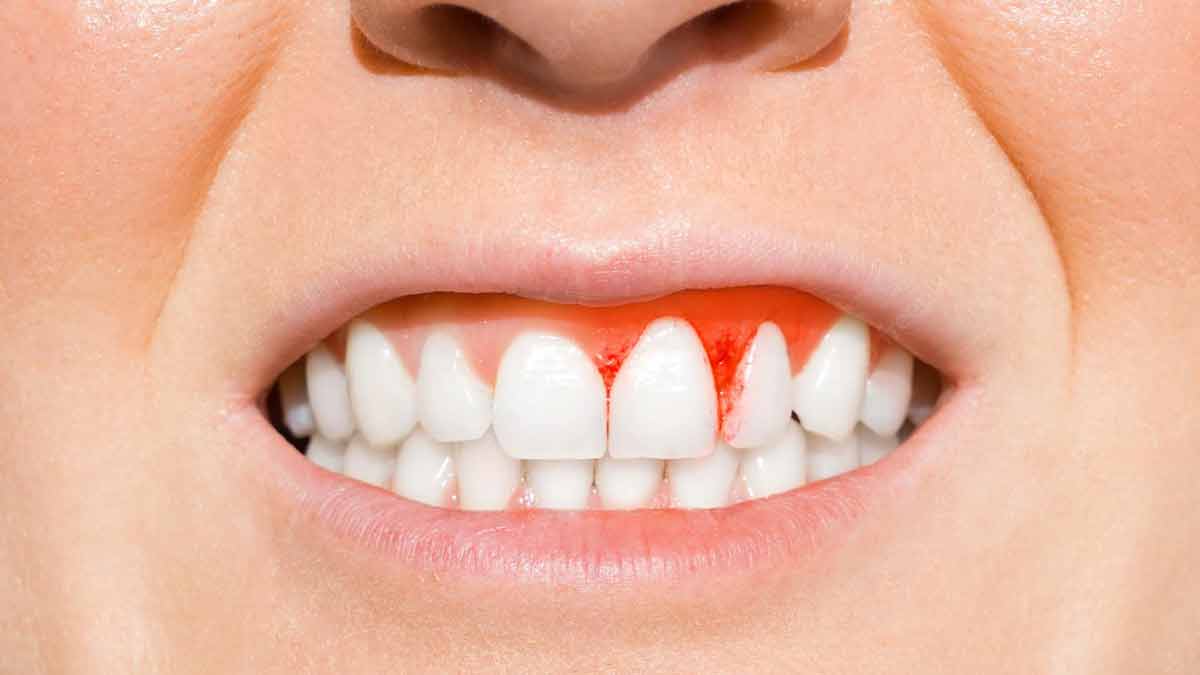 स्कर्वी नामक बीमारी किस विटामिन की कमी से होती है? vitamin c scurvy