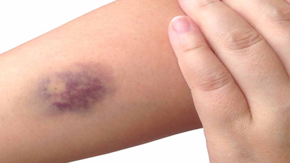 ब्लड क्लॉटिंग की समस्या होने पर कौन सा विटामिन शरीर में कम होता है? vitamin k and blood clots