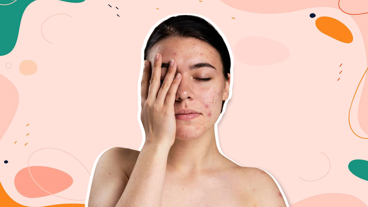 How Should hormonal acne be treated