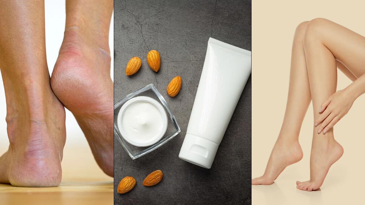 Top 10 Home Remedies for Cracked Heels | Tips for Natural Beauty