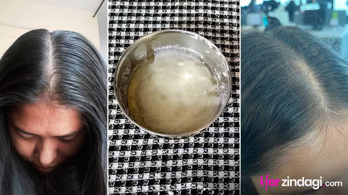 camphor and coconut oil for dandruff and hair fall