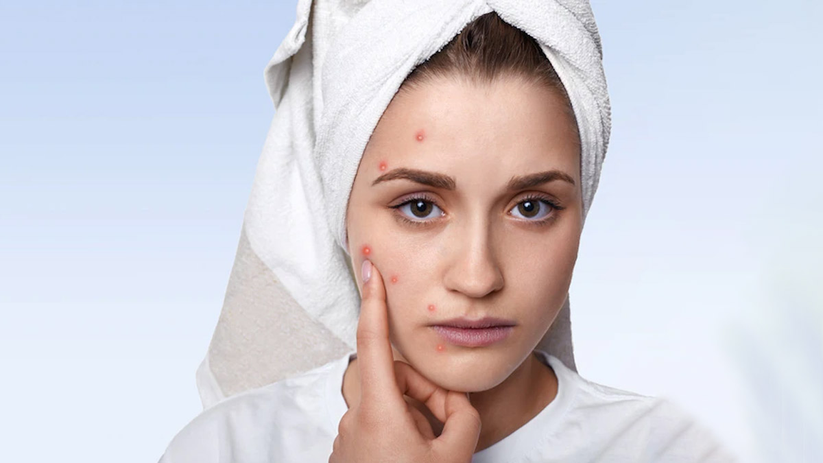 easy tricks to hide pimples without makeup