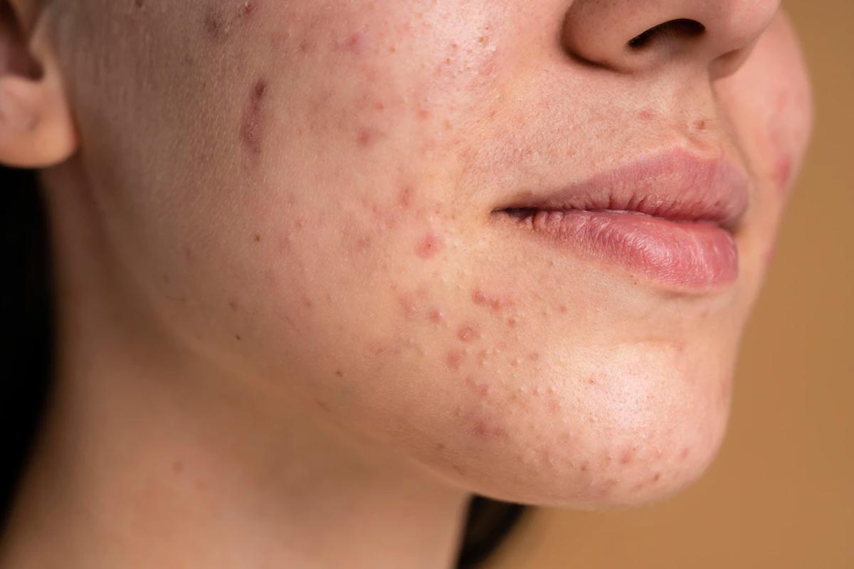 hormonal acne ki samasya