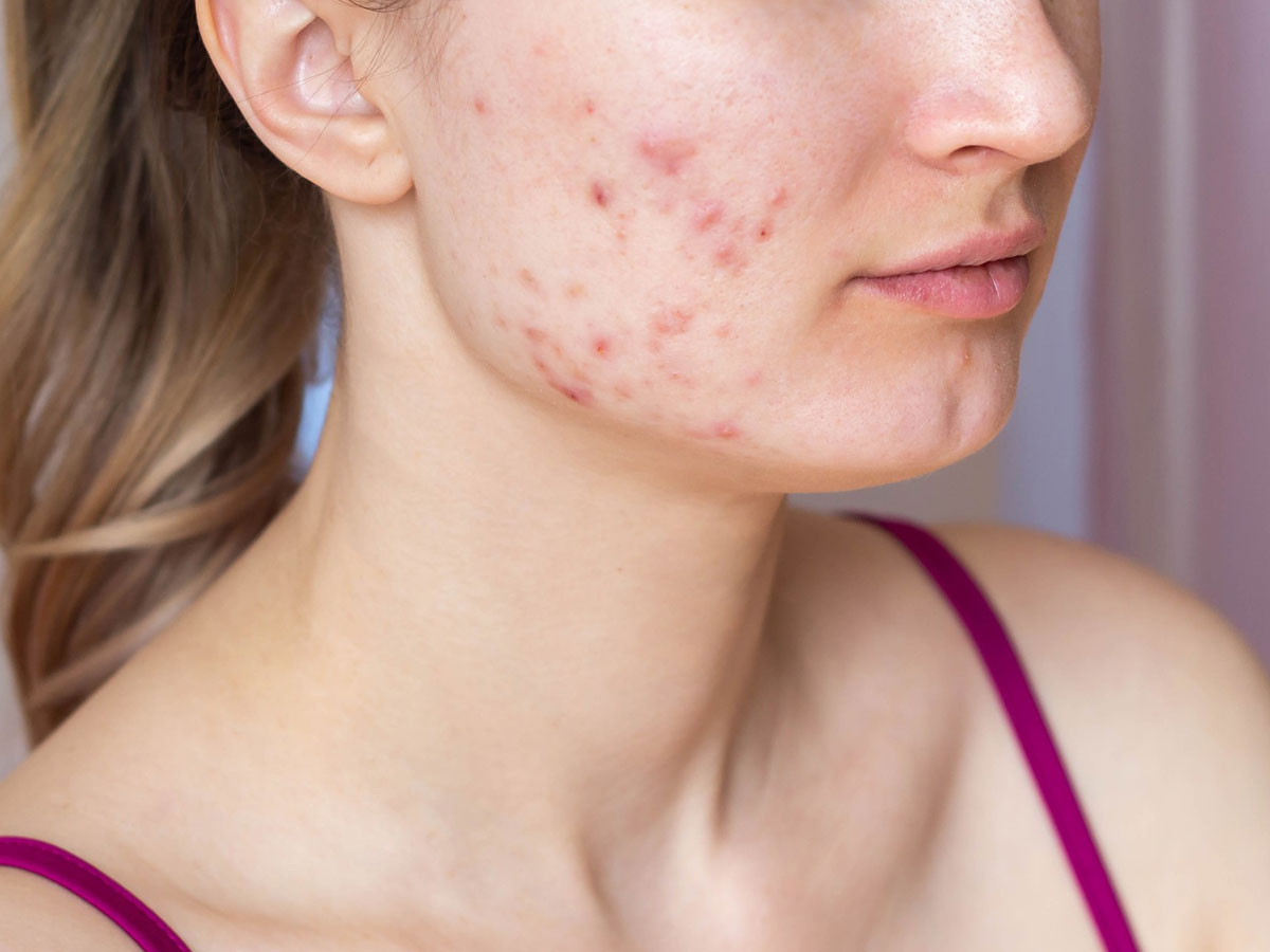 what is acne breakouts