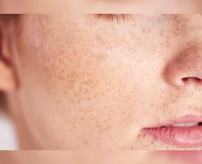 acne pigmentation homemade oil