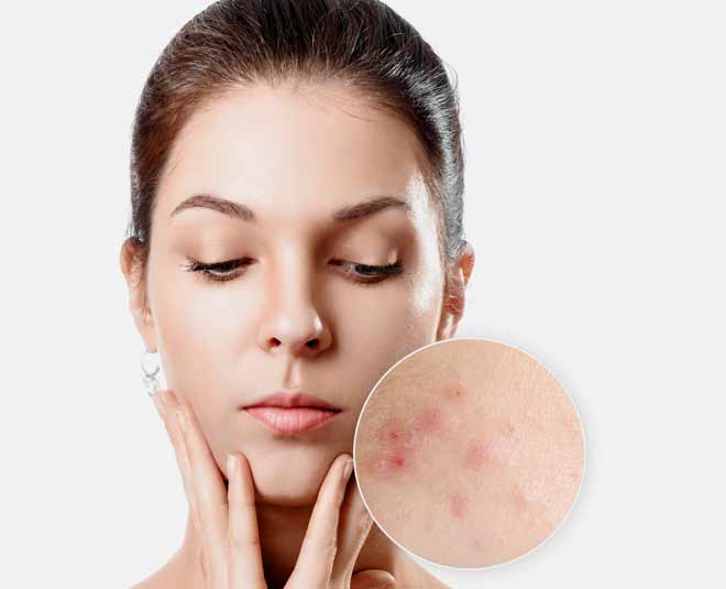 acne problems for skin