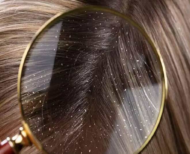 dandruff winter essentials care