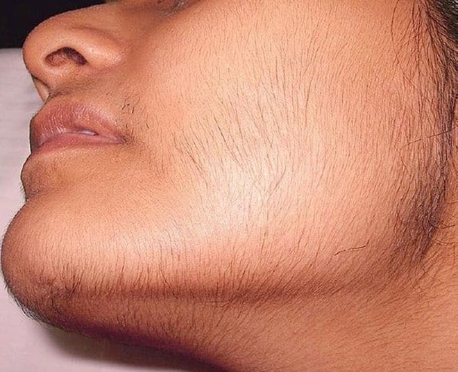 face hair and its issues