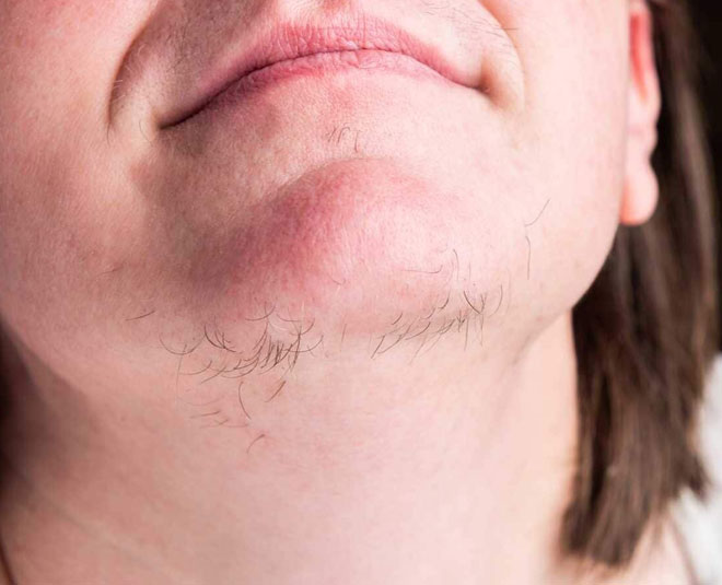 face hair and its problems