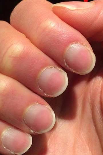 zinc deficiency can cause of white spots on your nails, know the zinc rich  foods list -कैल्शियम ही नहीं इन कारणों से भी नाखून पर दिखते हैं सफेद निशान,  एक्सपर्ट से जानिए |