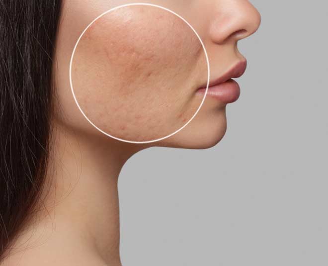natural  oils  for  hyperpigmentation