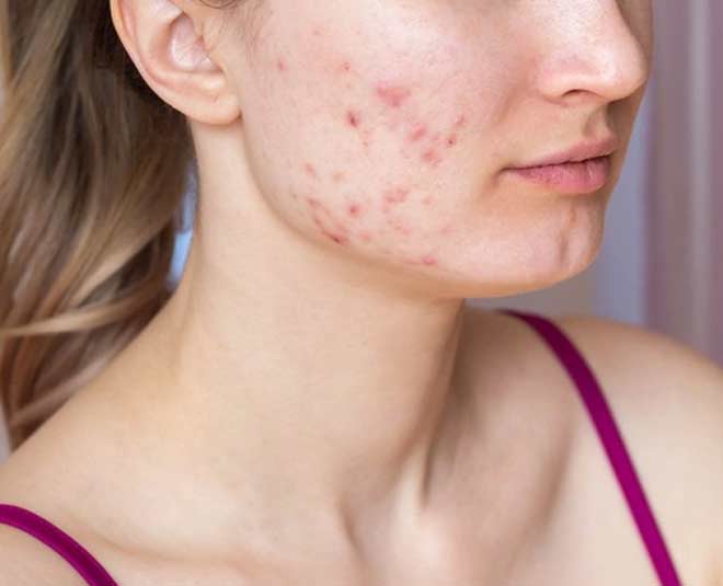 मुहांसे ठीक करे जीरा anti acne cumin seeds
