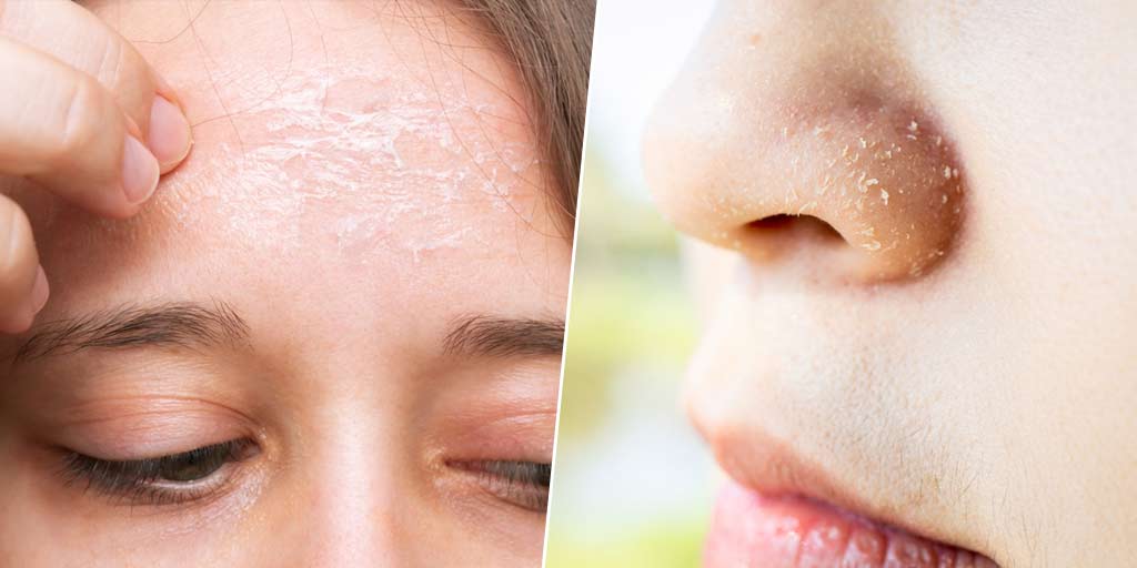 flaky-skin-on-nose-and-forehead-home-treatment-by-expert-flaky-skin