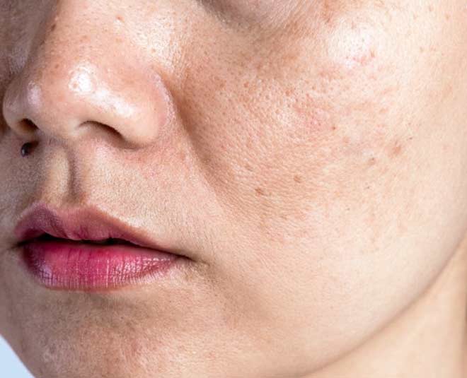 स्किन पिगमेंटेशन को कम करे skin pigmentation cumin seeds
