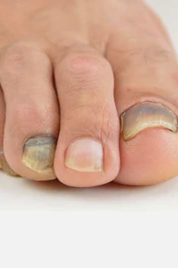 Blisters, Black Toenails and Runner's Feet: The Bad & The Ugly (There is No  Good)