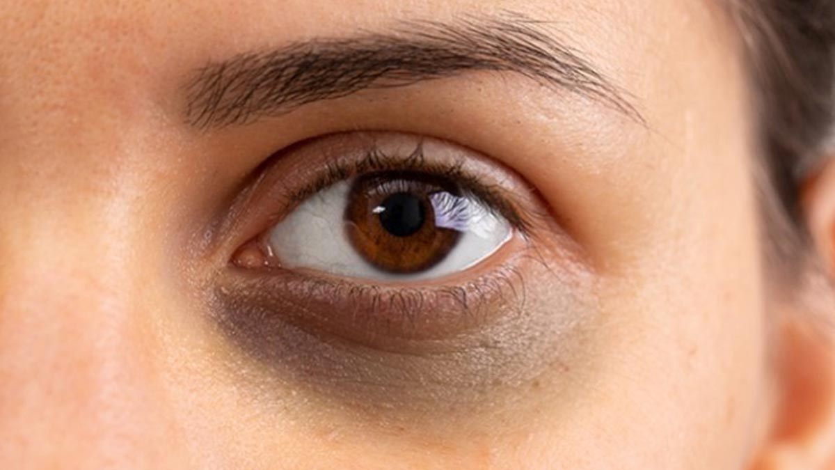 How dark circles can be treated