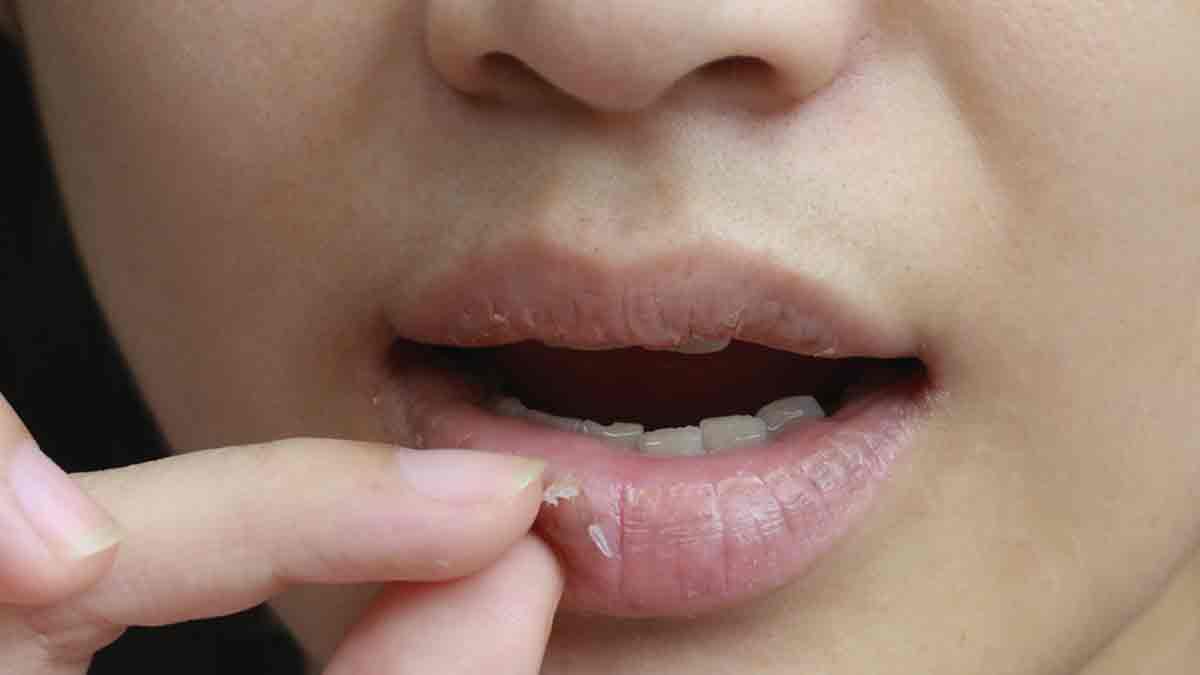 balm for chapped lips