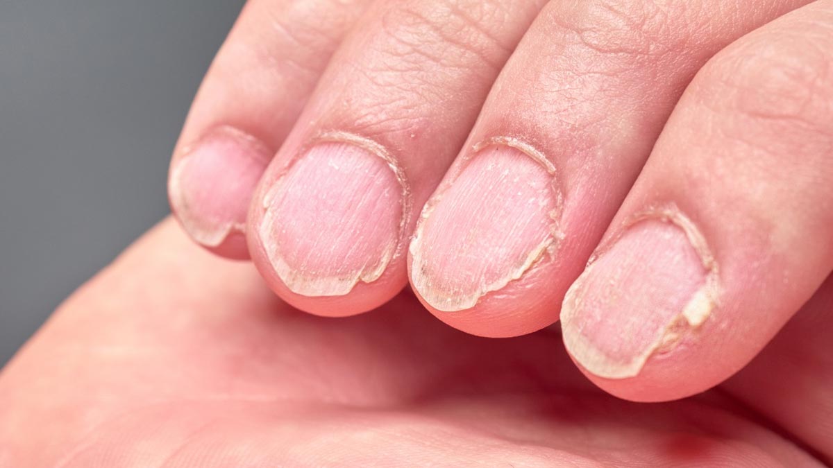 brittle nails sign of thyroid