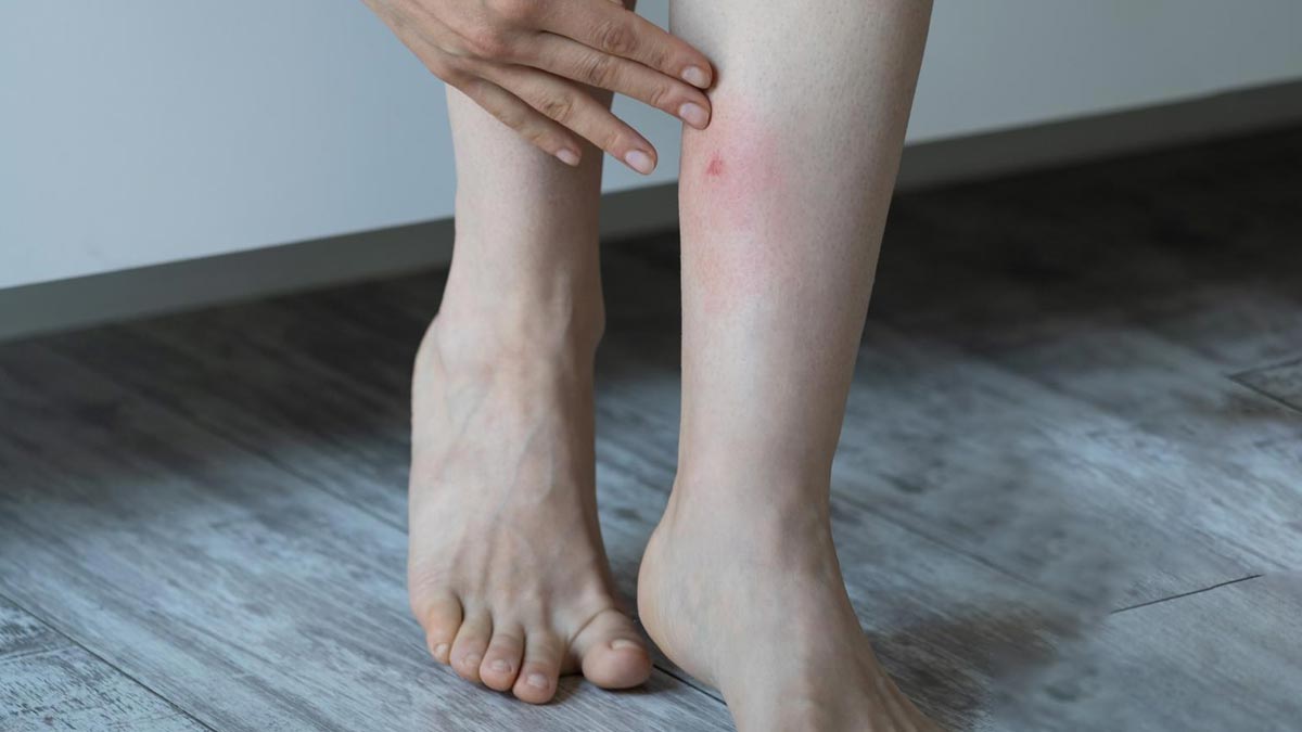 Mosquito Repellent Skin Side Effects मच्छर भगाने की क्रीम के स्किन