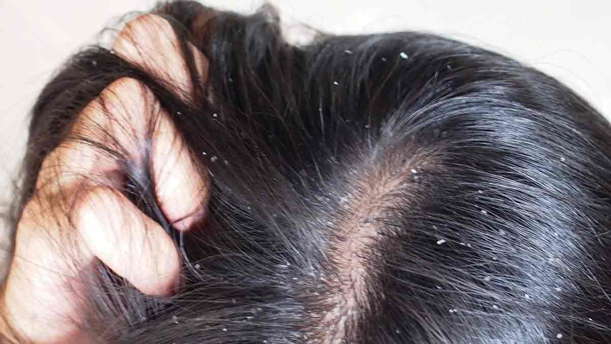 Dandruff हेयर मास्क कैसे बनाएं Hair Mask Lagane Ke Faydeडैंड्रफ की