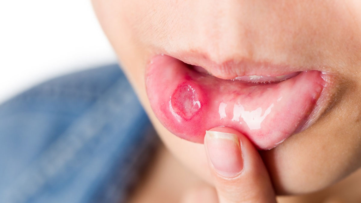 Mouth Ulcers| मुंह के छाले| Muh me Chale Hone ke Karan | mouth ulcers cure  | HerZindagi