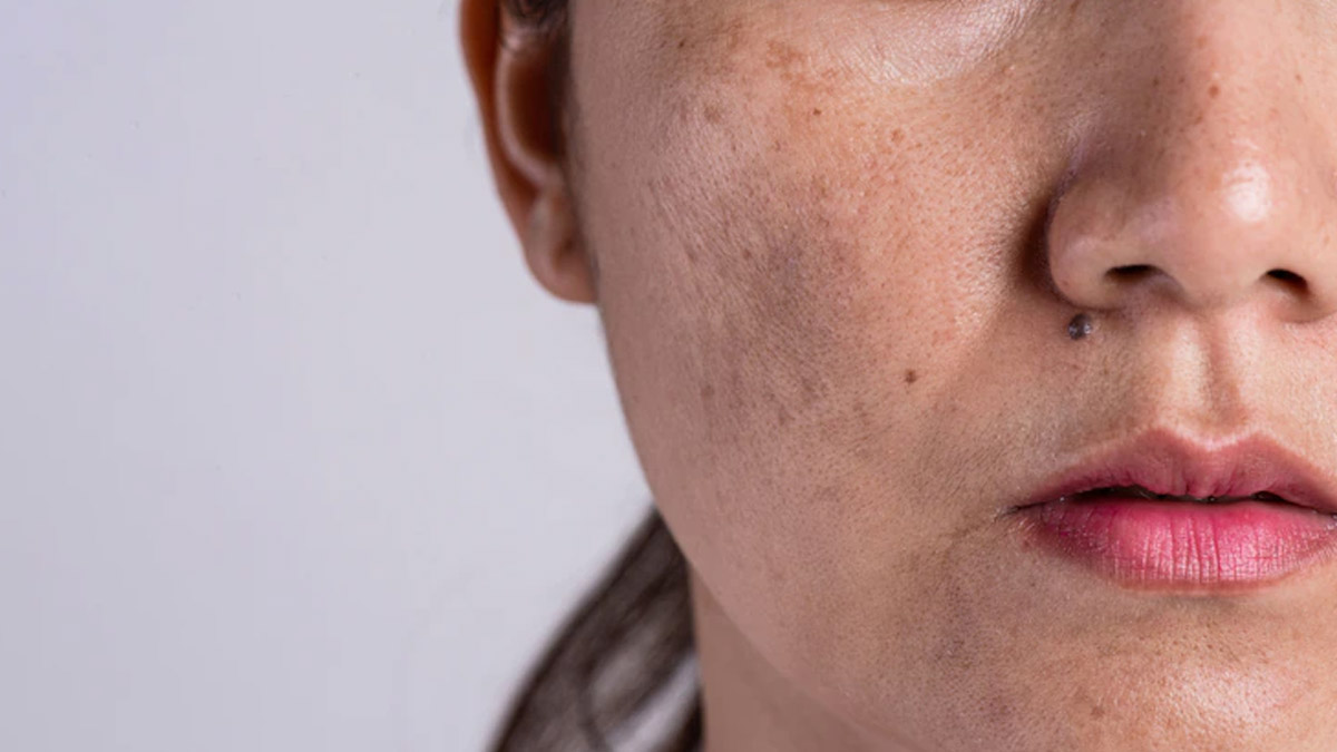 pigmentation reasons by expert in hindi