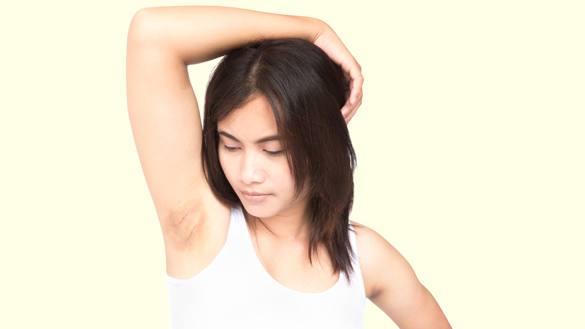 underarms acne scars treatment at home tips