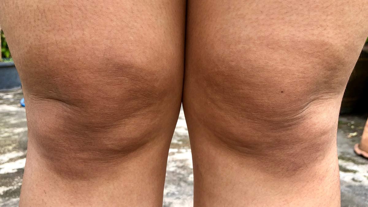why do knees turn black