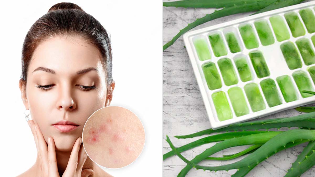 Is Aloe Vera Ice Cubes Good For Acneचेहरे से पिंपल कैसे हटाए घरेलू