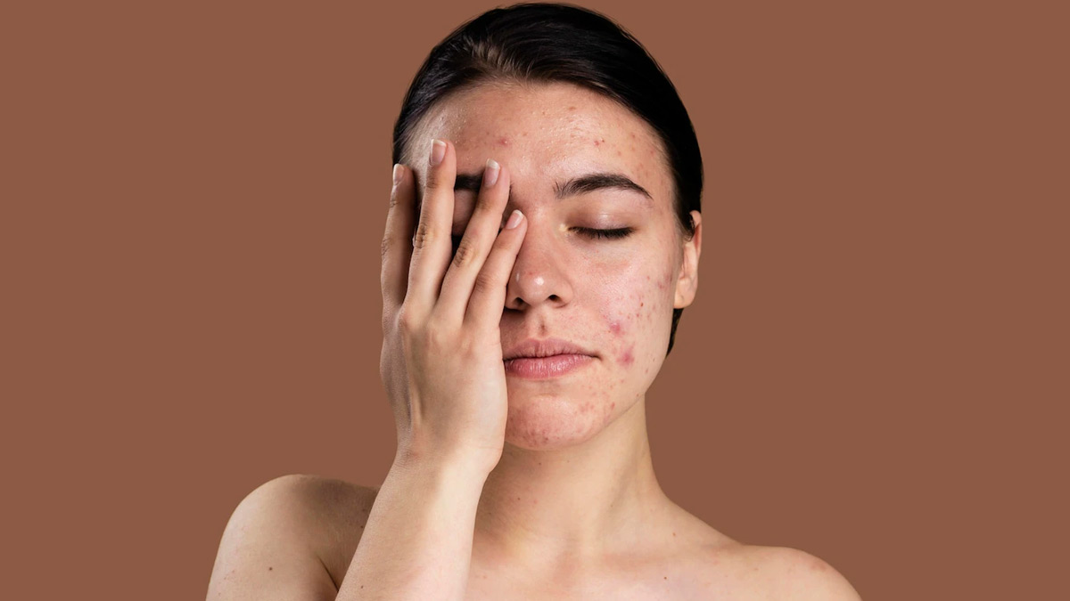 chandan face pack for acne