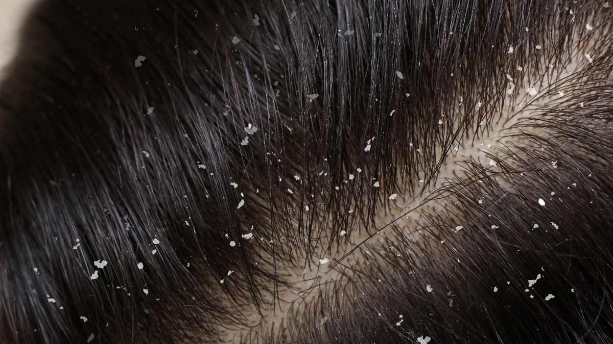 dandruff problems with summer